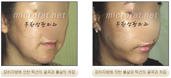 [Duhan Plastic Surgery Liposuction] - [Facial Liposuction] image 2