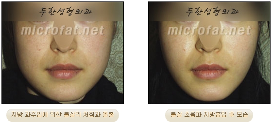 [Duhan Plastic Surgery Liposuction] - [Facial Liposuction] image 18