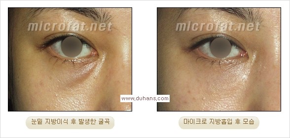 ​[두한성형외과 경쟁력 지방이식] - [지방이식 부작용 이후 마이크로 지방흡입, 마이크로 지방흡입 이후 부작용 없는 지방이식 방법] 관련 이미지 10