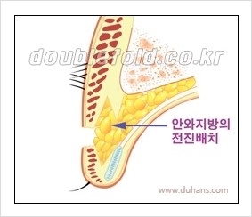 [두한성형외과 경쟁력 눈성형] - [쌍꺼풀 재수술 실패의 원인과 문제점] 관련 이미지 4