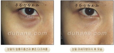 두한성형외과 눈밑성형 - 눈밑지방제거, 눈밑주름, 눈밑지방재배치 관련 이미지 78