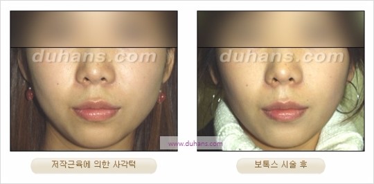 [두한성형외과 경쟁력 안면윤곽성형] - [보톡스(보툴리눔톡신)에 의한 사각턱 교정] 관련 이미지 8