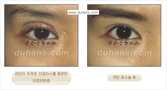 [두한성형외과 경쟁력 눈성형] - [두꺼운 라인을 교정하는 극한 눈 재수술 2.] 관련 이미지 4