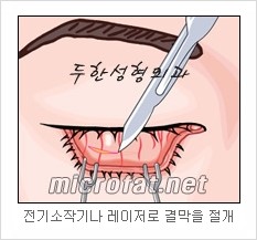두한성형외과 눈밑성형 - 눈밑지방제거, 눈밑주름, 눈밑지방재배치 관련 이미지 5