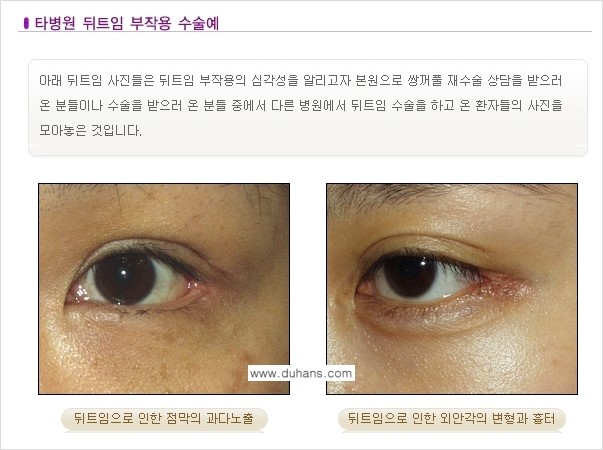 [두한성형외과 경쟁력 눈성형] - [뒤트임 수술 부작용 안내] 관련 이미지 2