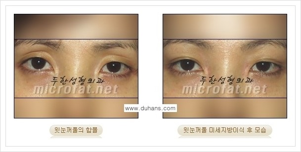 [두한성형외과의 경쟁력 미세지방이식] - [꺼진 눈꺼풀(윗눈꺼풀 함몰) 미세지방이식 안내] 관련 이미지 1
