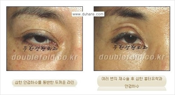 [두한성형외과 경쟁력 쌍꺼풀 재수술] - [두꺼운 라인을 교정하는 극한 재수술(Extreme Rroperation)] 관련 이미지 2