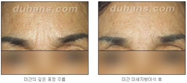 [두한성형외과 주름교정] - [지방이식을 이용한 주름개선] 관련 이미지 14