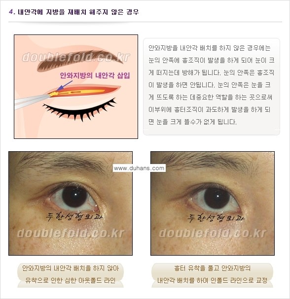 [두한성형외과 경쟁력 쌍꺼풀 재수술, 극한 눈재수술] - [쌍꺼풀 재수술, 눈 재수술의 실패 원인] 관련 이미지 4