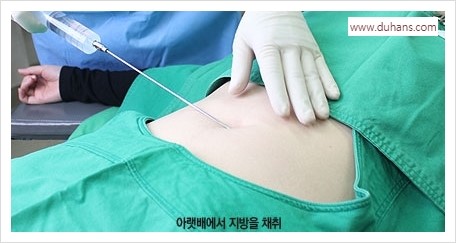 [두한성형외과 경쟁력 눈밑성형] - [눈밑애교살 시술을 위한 미세지방이식] 관련 이미지 6