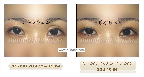 [두한성형외과 경쟁력 쌍꺼풀 재수술] - [비대칭(짝짝이) 쌍꺼풀 라인 교정하는 방법 안내 ①] 관련 이미지 9