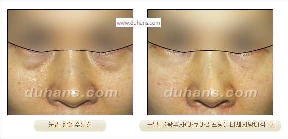 [두한성형외과 경쟁력 주름성형] - [간단하고 부작용 없는 자연스러운 주름제거 방법] 관련 이미지 23