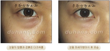 두한성형외과 눈밑성형 - 눈밑지방제거, 눈밑주름, 눈밑지방재배치 관련 이미지 79