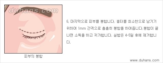 [두한성형외과 경쟁력 눈성형] - [상큼하고 환한 젊은 눈매 상안검성형(윗눈꺼풀 처짐) 안내] 관련 이미지 6