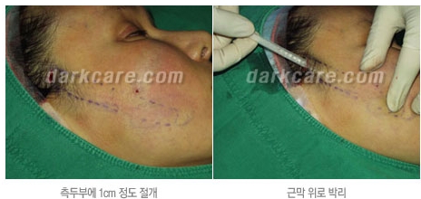 Duhan Plastic Surgery Combo Program - Dark Circles and Lifting image 11