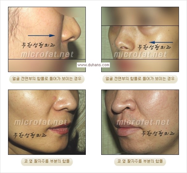 [두한성형외과의 경쟁력 미세지방이식] - [귀족수술 + 인디언밴드 미세지방이식 안내] 관련 이미지 1