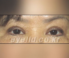 Duhan Plastic Surgery Eye Surgery - Are You a Candidate for Double Eyelid Revision Surgery?! image 6