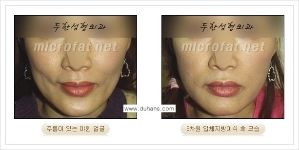 ⁠⁠[두한성형외과 경쟁력 볼살지방이식] - [심하게 야윈 주름이 있는 얼굴, 역삼각형 협소한 얼굴, 광대뼈가 돌출되어 보이는 경우 안내] 관련 이미지 10