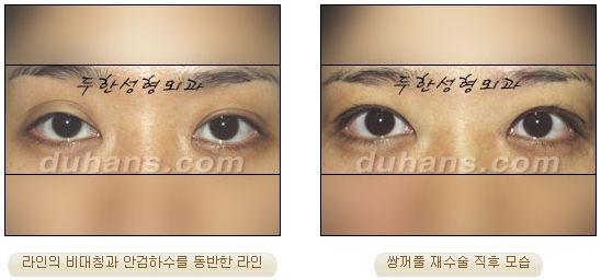 [Duhan Plastic Surgery Double Eyelid Revision Surgery] - [Beautiful Double Eyelids] image 18
