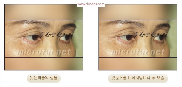 [두한성형외과 경쟁력 눈성형 리더] - [윗눈꺼풀 함몰( #꺼진눈꺼풀) 미세지방이식과 상안검성형]#꺼진눈성형 , #눈위함몰 관련 이미지 23
