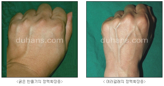 [두한성형외과 정맥류] - [하지정맥류, 정맥확장증, 혈관확장증] 관련 이미지 48