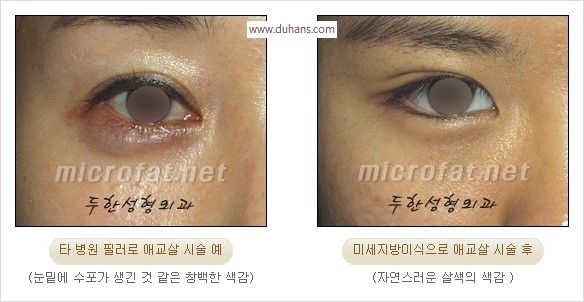 [두한성형외과 경쟁력 눈밑성형] - [눈밑애교살 필러 시술의 부작용 교정 방법] 관련 이미지 4