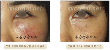 Facial Fat Liposuction at Duhan Plastic Surgery - Cheek Fat Liposuction, Jawline Liposuction, Under-Eye Fat Liposuction image 19