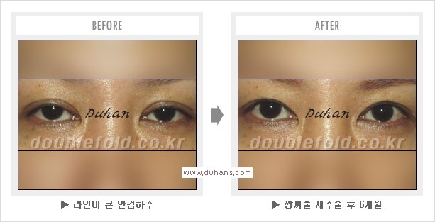 [두한성형외과 쌍꺼풀 재수술, 극한 눈재수술] - [재수술에 대한 자주하는 질문과 답변 안내] 관련 이미지 6