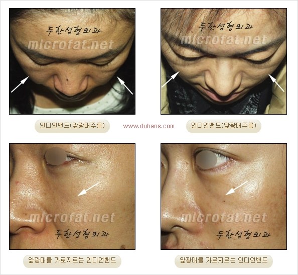 [두한성형외과의 경쟁력 미세지방이식] - [귀족수술 + 인디언밴드 미세지방이식 안내] 관련 이미지 2