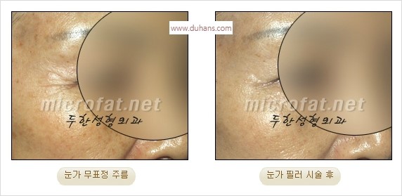 [두한성형외과 경쟁력 Quick성형] - [주름교정을 위한 필러 시술] 관련 이미지 10