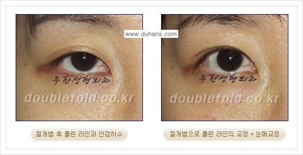 [두한성형외과 경쟁력 쌍꺼풀 재수술, 극한 재수술] - [쌍꺼풀 라인이 풀렸을 경우 쌍꺼풀 재수술 안내] 관련 이미지 3