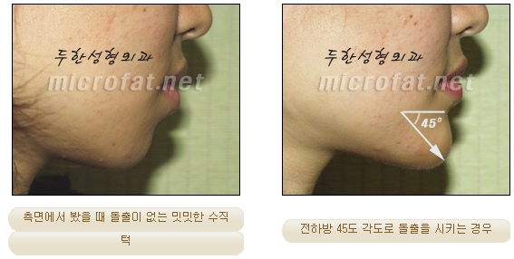 [두한성형외과 미세지방이식] - [무턱교정 안내] 관련 이미지 7