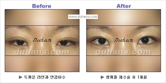 [두한성형외과 경쟁력 눈성형] - [Dr. 컬럼  "어떤 쌍꺼풀이 아름다운 쌍꺼풀인가?!] 관련 이미지 10