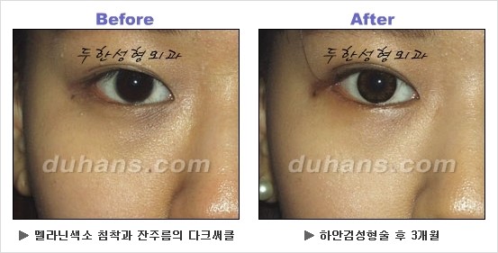 [두한성형외과 경쟁력 동안성형 리더] - ​[미간주름, 이마주름, 안검성형, 이마거상술, 눈썹거상술] 관련 이미지 103