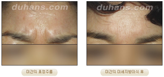 [Duhan Plastic Surgery Facial Autologous Fat Grafting] - [Fat Grafting Guide] image 6