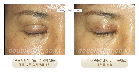 [두한성형외과 경쟁력 쌍꺼풀 재수술, 극한 재수술] - [쌍꺼풀 재수술에서 극복해야 할 극한의 상황과 문제들] 관련 이미지 2