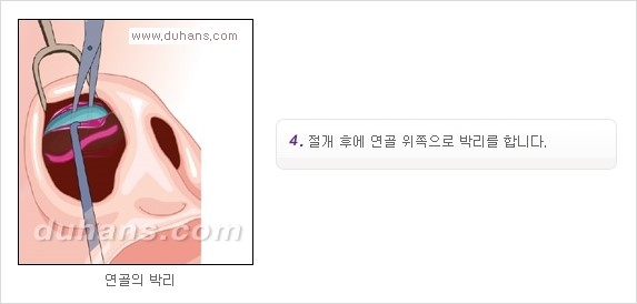[두한성형외과 경쟁력 코성형] - [코성형을 위한 알로덤(슈어덤) 수술, 실리콘 수술 안내] 관련 이미지 7