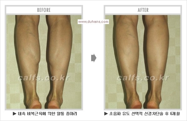 [두한성형외과 경쟁력 멀티종아리성형] - [알통종아리 해결 - 비절개 초음파 선택적 신경차단술] 관련 이미지 21