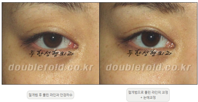 [두한성형외과 쌍커풀재수술] - [풀린 쌍커풀라인 교정] 관련 이미지 5