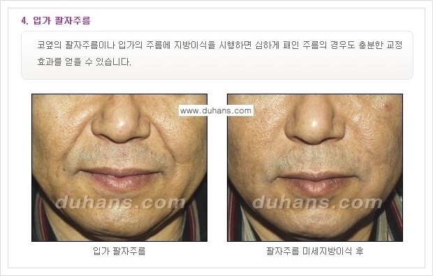 ​[두한성형외과 경쟁력 주름성형] - [주름교정을 위한 미세지방이식 안내 2.] 관련 이미지 2