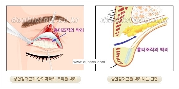 [두한성형외과 경쟁력 눈성형] - [안검하수(졸린 눈매) 재수술 안내 ②] 관련 이미지 6