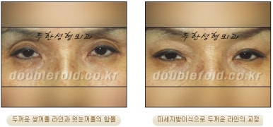 [Duhan Plastic Surgery Revision Double Eyelid Surgery] - [Double Eyelid Revision Surgery Process] image 38
