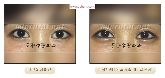 ​﻿[두한성형외과 경쟁력 지방이식] - [눈밑 애교살 시술을 위한 미세지방이식] 관련 이미지 34
