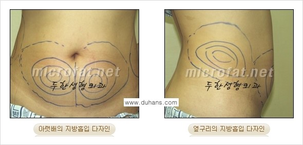 [두한성형외과 경쟁력 바디성형] - [하복부, 팔뚝, 허리선, 허벅지, 엉덩이 간편지방흡입술] 관련 이미지 5