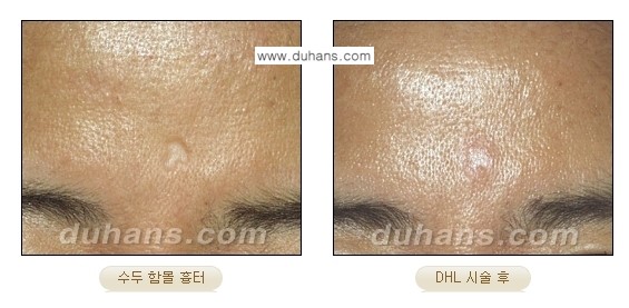 [두한성형외과 흉터 교정] - [함몰흉터의 DHC 시술] 관련 이미지 11