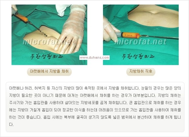[두한성형외과 경쟁력 눈밑성형] - [눈밑 애교살 시술을 위한 미세지방이식] 관련 이미지 4
