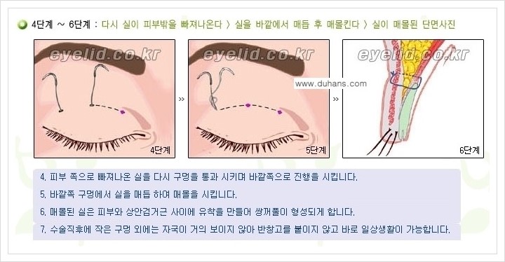 [두한성형외과 경쟁력 눈성형] - [절개법, 매몰법 쌍꺼풀 수술 안내] 관련 이미지 7