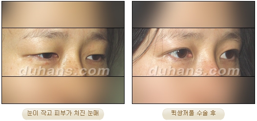[Duhan Plastic Surgery Double Eyelid Surgery] - [Types of Double Eyelid Surgery] image 21