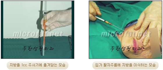 Wrinkle Improvement, Duhan Plastic Surgery - Mouth Lines, Nasolabial Folds image 7