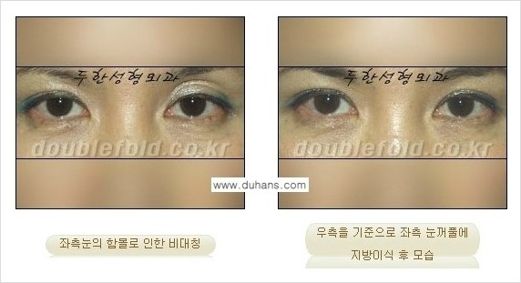 [두한성형외과 경쟁력 쌍꺼풀 재수술] - [쌍꺼풀 재수술 과정] 관련 이미지 103